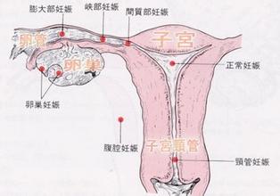 宫外孕手术多少钱?