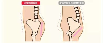 预防骨盆疼痛及保护骨盆的方法有