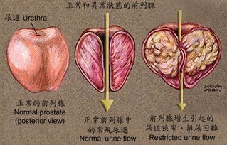 前列腺炎会传染给妻子吗会引起妇科病噢