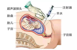 无创dna和羊水穿刺哪个准确率高一点