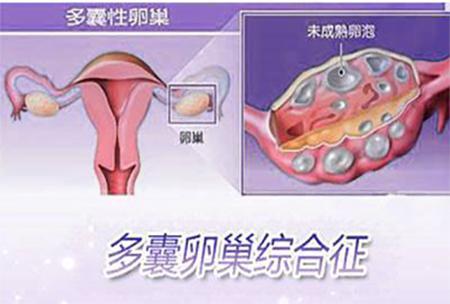 患了多囊卵巢综合征该怎么办