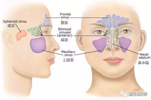 关于流行性感冒引起的鼻窦炎