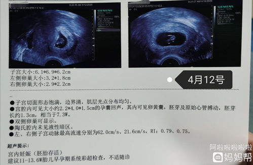 nt值多少为正常