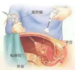 宫腔镜手术后怎样调养恢复快