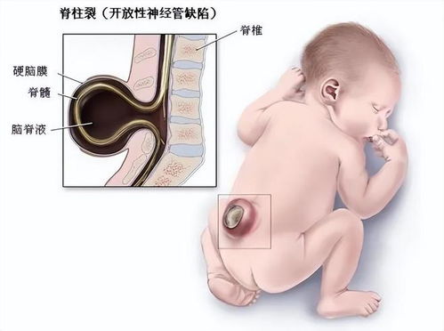 完全纵膈子宫妊娠15周合并卵巢畸胎瘤