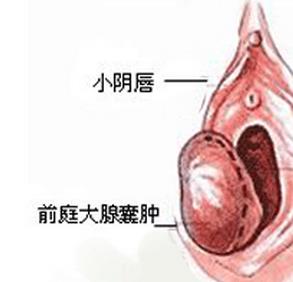 处女会不会得前庭大腺炎