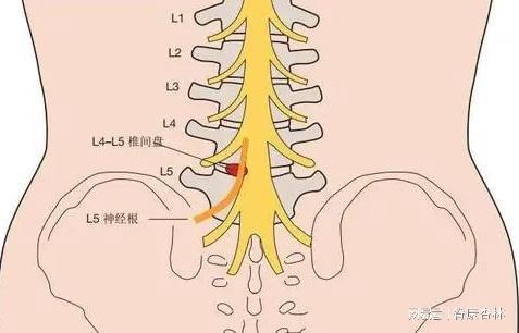 肠癌一般发现是哪期