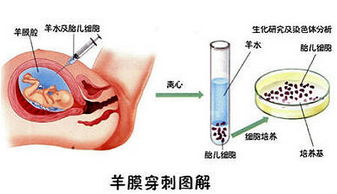 羊水穿刺什么时候做最好?