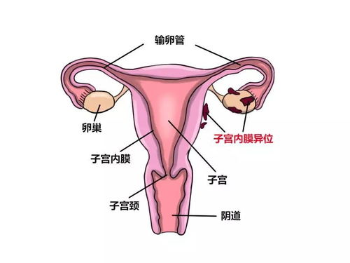 女性盆腔粘连是什么意思