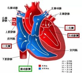 胎儿肺动脉瓣狭窄严重吗怎么办