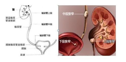 孕妇输尿管结石不能吃什么水果