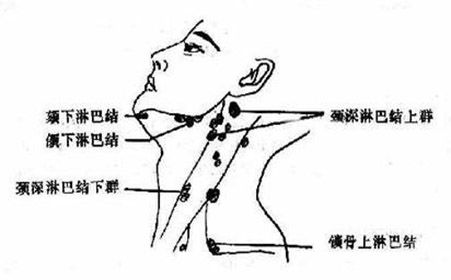 经常熬夜会导致淋巴结肿大吗