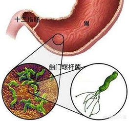 怎么检查幽门螺杆菌？