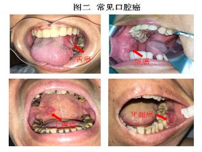 智齿反复磨损口腔黏膜会致癌吗