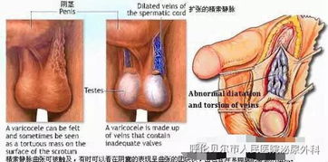 精索静脉曲张多少mm算轻度