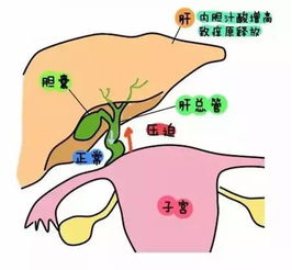 新生儿胆汁淤积症怎么治疗