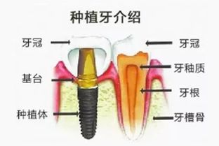 种植一颗牙多少钱？