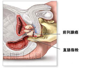 癌症早期症状