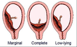轮状胎盘有什么危险吗