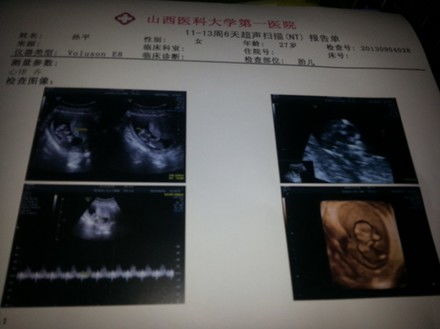 12周做nt检查结果1、04正常吗？