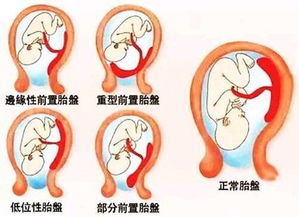 胎盘老化能喝牛奶吗?