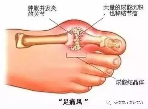 支气管炎偏方