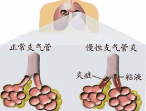 慢性支气管炎的偏方