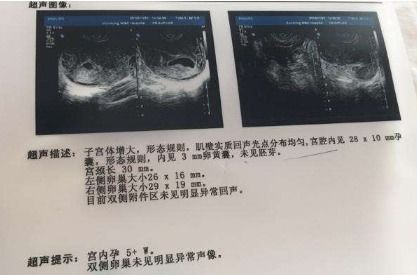 做B超能确定怀孕的时间吗？