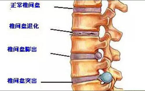 为什么女性容易得胆囊炎