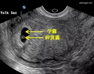 孕囊形状是长形的还是圆形的？