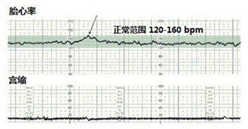 胎心监护得了10分，但胎心快对宝宝有影响吗