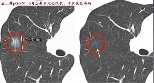 流产后卵黄囊什么时候消失