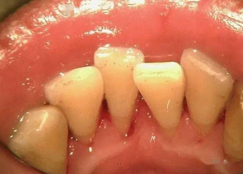 牙龈萎缩怎么做假牙好