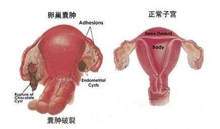 患有卵巢囊肿严重吗？