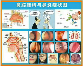 鼻炎不治疗的后果是什么