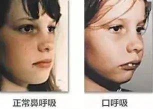 鼻窦炎长期不治疗会怎样？求大神帮助