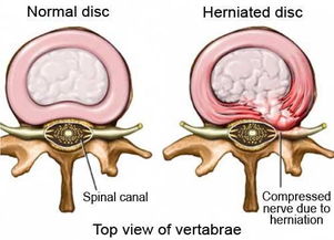 第4第5节腰椎间盘突出怎么治疗