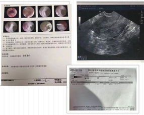 宫腔镜手术多久可以移植囊胚