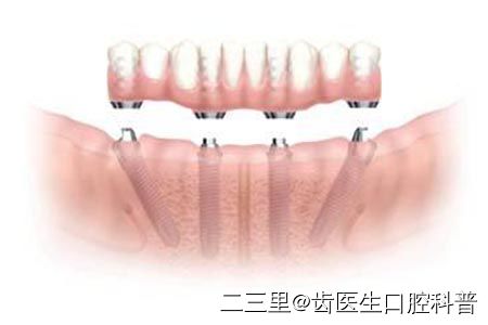 老人镶牙都有什么方法