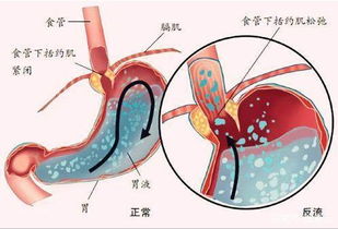 怀孕了胃总是反酸怎么回事