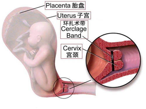 宫颈机能不全的原因有哪些