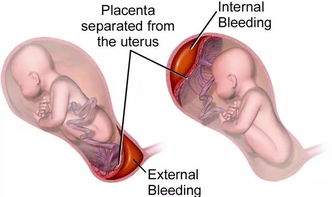 怀孕后期如何预防胎盘早剥呢