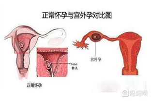 为什么现在宫外孕的人越来越多了