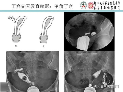 女性做完输卵管造影后多久可以同房