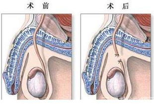 曼月乐环上完可以直接走吗