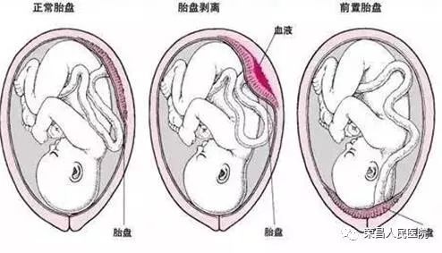 孕妇胎盘早剥的症状