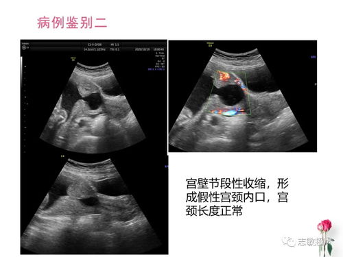 宫颈机能不全平常表现有哪些