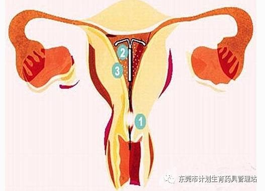 取环会出血吗,出血几天