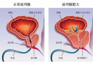 前庭大腺囊肿可以性生活么有影响么