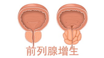 前庭大腺囊肿可以性生活么有影响么